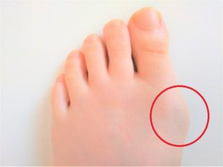 外反母趾による足の親指のつけ根の痛み